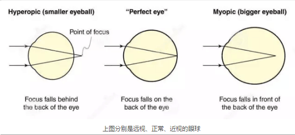 学生屈光不正