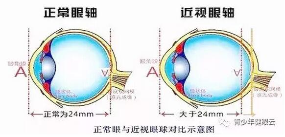 近视眼球结构