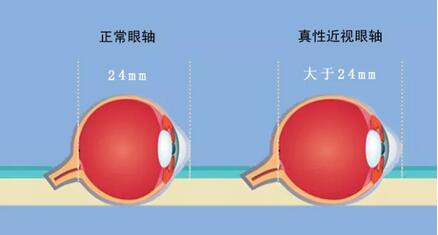 真性近视为眼睛本身器质发生了改变