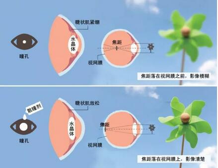 点散瞳药水可以放松睫状肌，消除假性近视