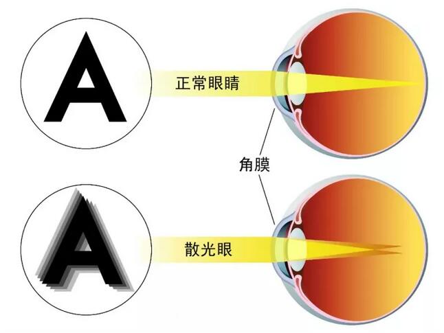 散光眼戴镜后如正常眼睛可聚焦在视网膜上，成像清晰