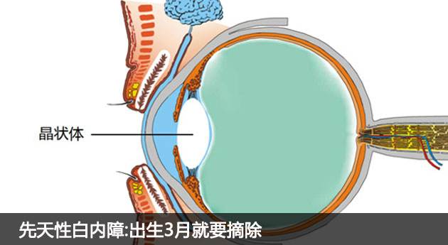 先天性白内障