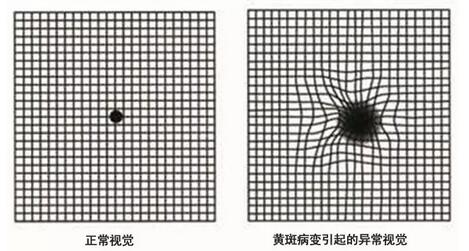 正常视觉与异常视觉对比