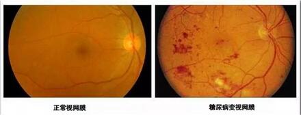 正常视网膜与糖尿病变视网膜