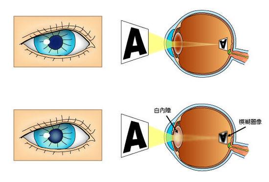 白内障眼球结构