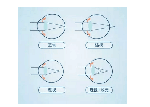 散光种类