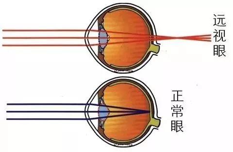 远视眼与正常眼